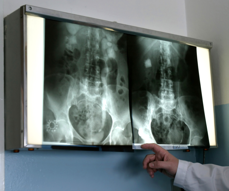 MRIs, CT Scans, And X-Rays Might Harm Your Kidneys | Shutterstock
