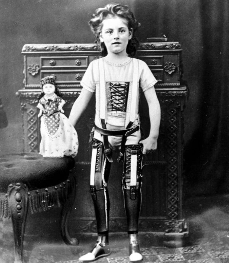 1890s Prosthetics | Getty Images Photo by Science & Society Picture Library