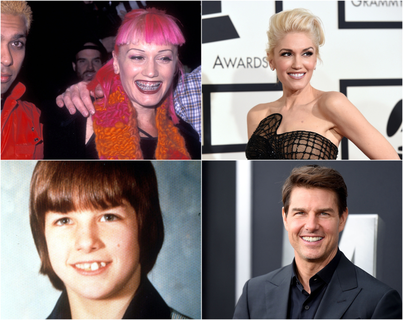These Celebs Spent a Pretty Penny on Getting Perfect Teeth | Getty Images Photo by Ron Galella, Ltd. & Jason Merritt & Alamy Stock Photo & Jamie McCarthy