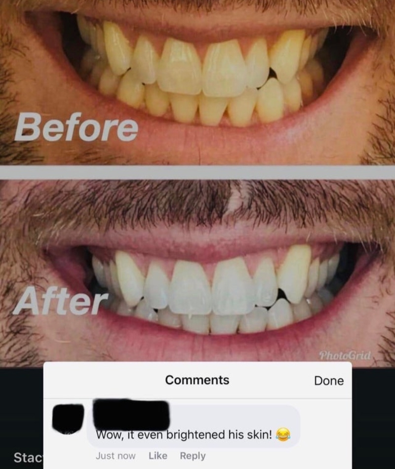 Teeth Whitening? | Reddit.com/PostComa