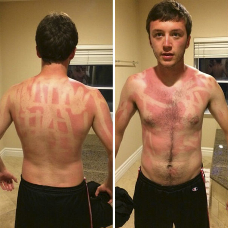 One of Many Tanning Mishaps | Imgur.com/dCzN3WC