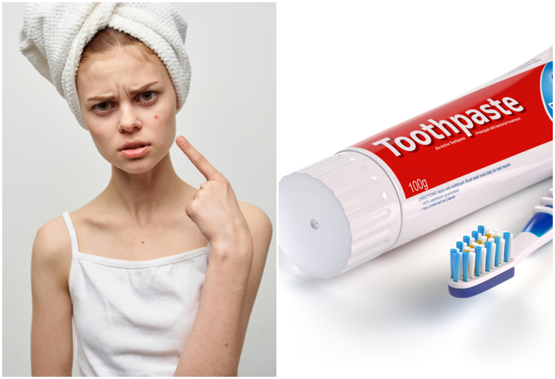 Applying Toothpaste to Your Pimples | Shutterstock
