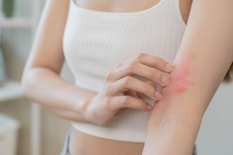 Itching Balm | Shutterstock Photo by Kmpzzz