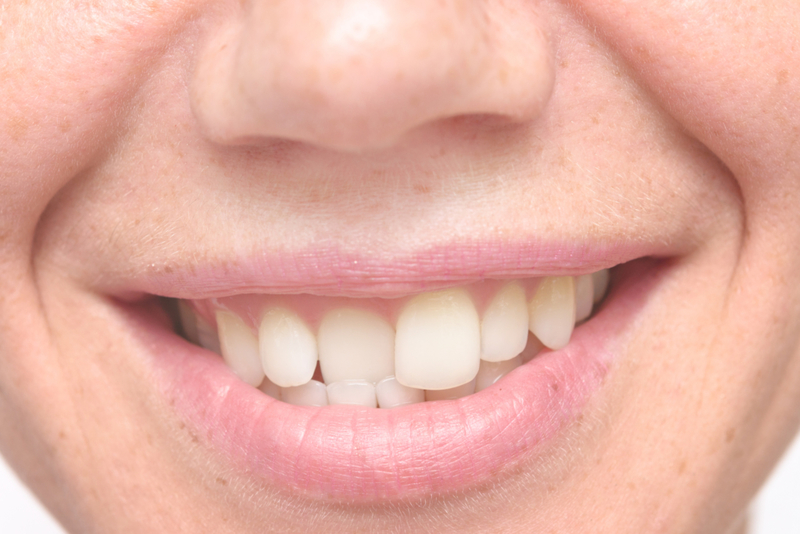 Crooked teeth | Getty Images Photo by RusN