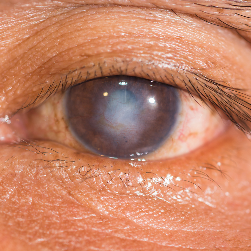 An Eyeball Scar | Shutterstock