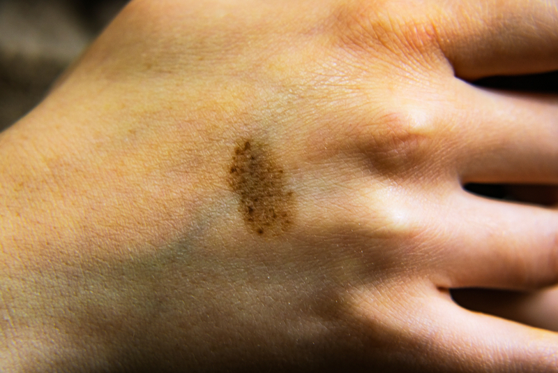The Birthmark on Holly’s Hand | kaskip/Shutterstock