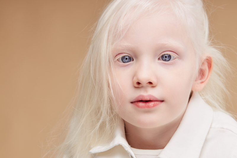 Okuläre Albinismus tut mehr als nur die Pigmentierung reduzieren | UfaBizPhoto/Shutterstock