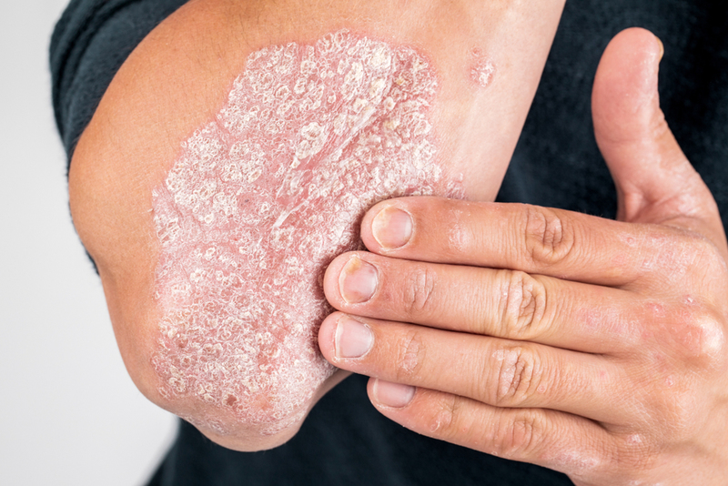 Psoriasis and Eczema Relief | Shutterstock